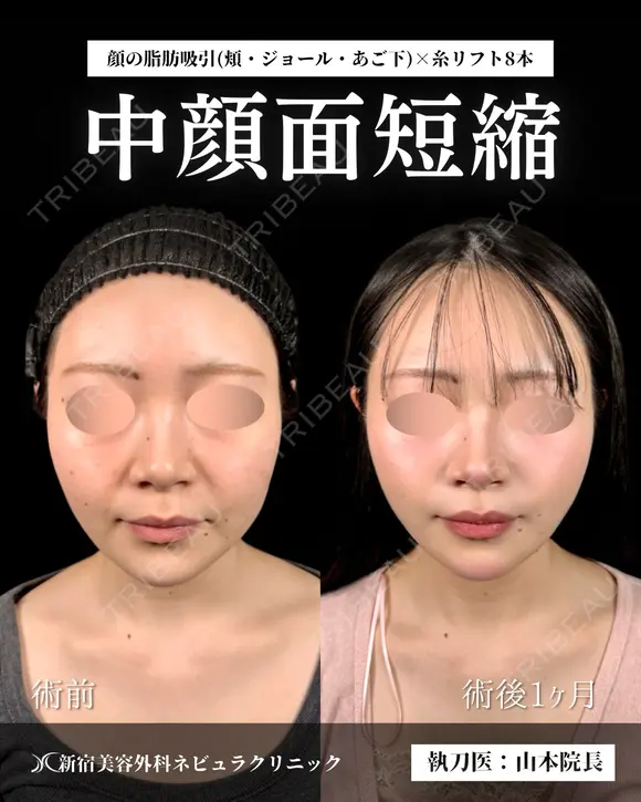 顔の脂肪吸引 30日後 メイン用