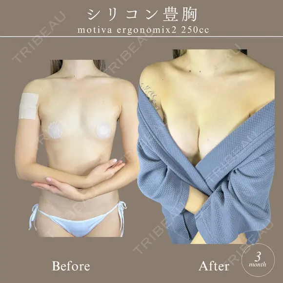 シリコンバッグ豊胸 before画像 メイン用