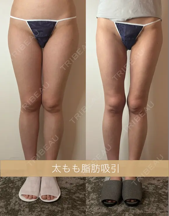 太もも脂肪吸引 90日後 メイン用
