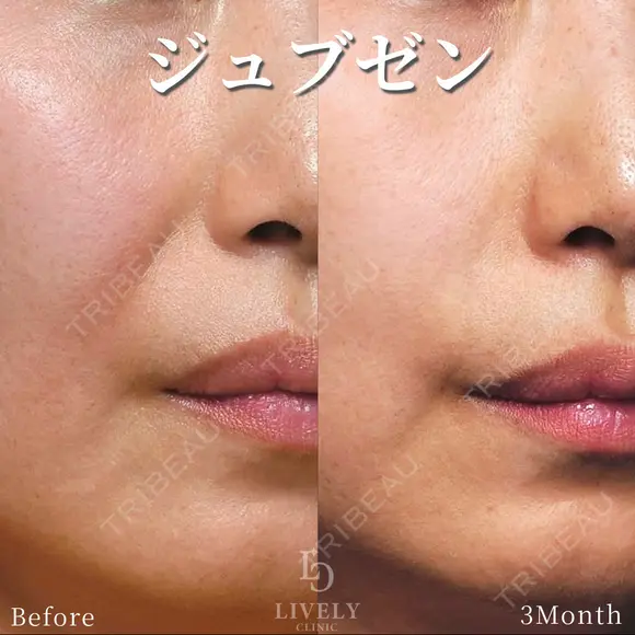 ジュブゼン after画像 メイン用