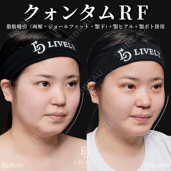 クォンタムRF before画像 メイン用