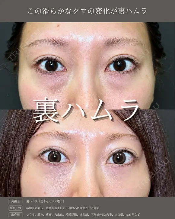 【クマ治療】裏ハムラ法 before画像 メイン用