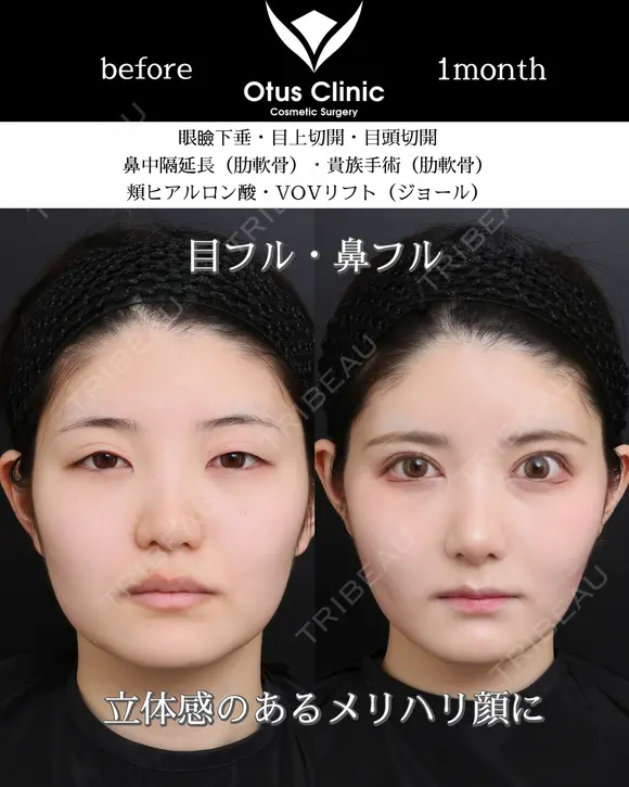 鼻中隔延長・鼻尖形成・貴族手術・眼瞼下垂・目頭切開・目上切開・頬ヒアルロン酸・糸リフト 30日後 メイン用