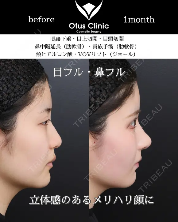 鼻中隔延長・鼻尖形成・貴族手術・眼瞼下垂・目頭切開・目上切開・頬ヒアルロン酸・糸リフト 30日後 メイン用