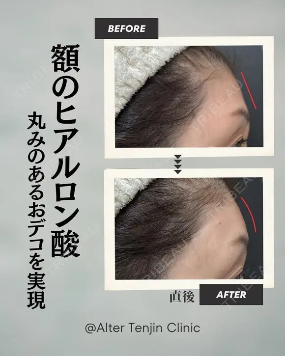 丸みのあるおでこを実現！ after画像 メイン用