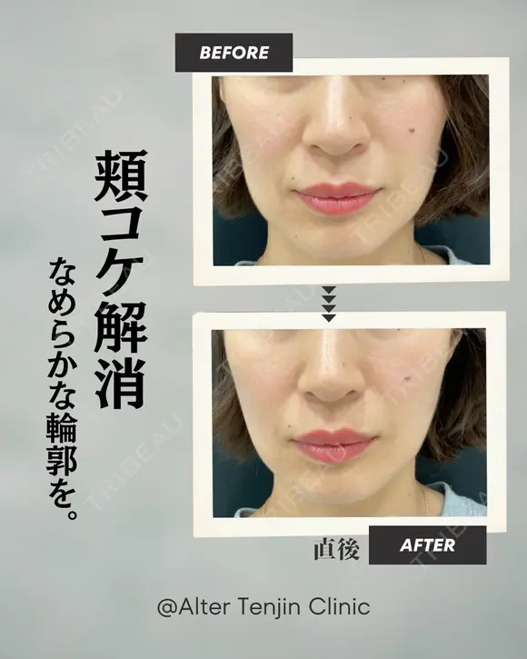 頬こけ解消！滑らかな輪郭を！ after画像 メイン用
