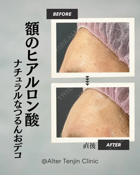 額のヒアルロン酸でナチュラルなつるんおでこ before画像 メイン用