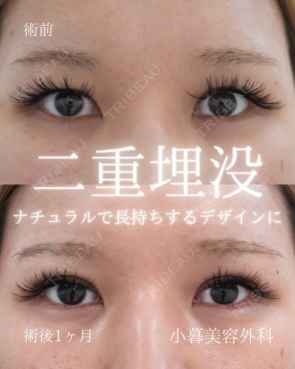 二重埋没 before画像 メイン用