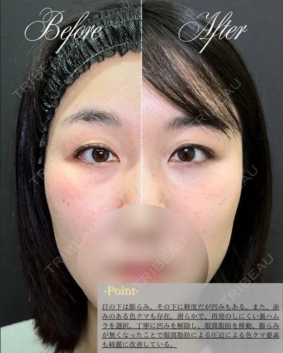 【クマ治療】裏ハムラ法 before画像 メイン用
