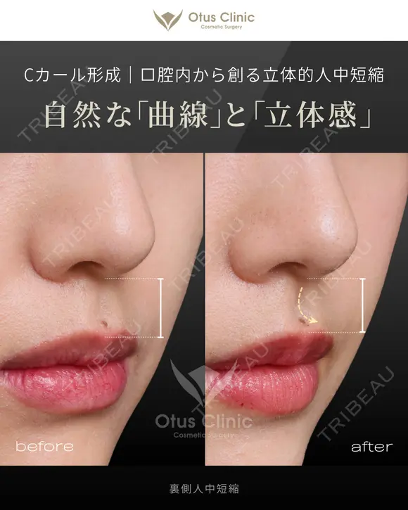 裏側人中短縮 before画像 メイン用