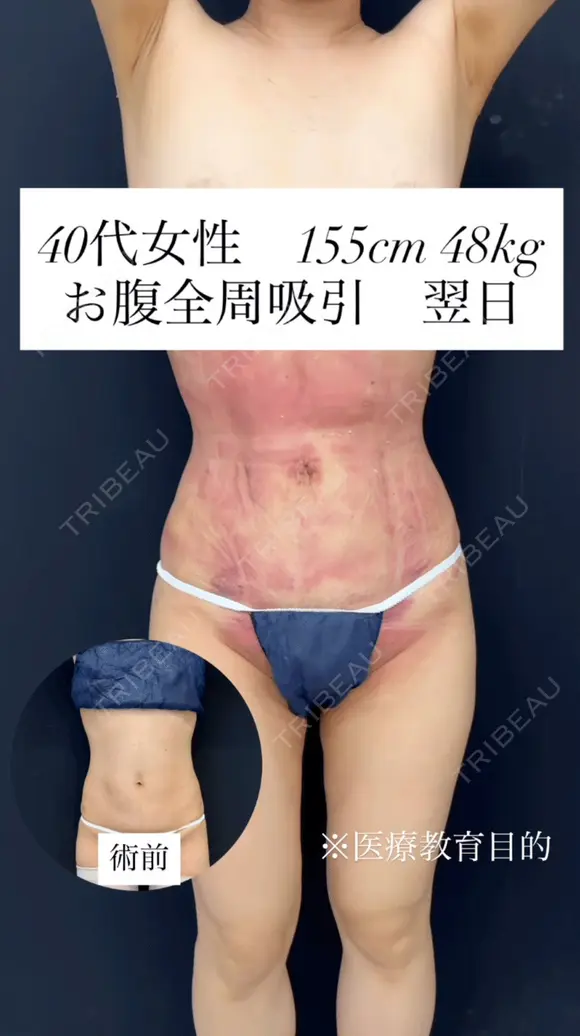 シークレット脂肪吸引お腹まわり before画像 メイン用