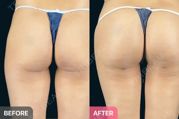 ブラジリアンバットリフト before画像 メイン用