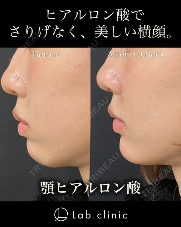 【ヒアルロン酸注入】顎ヒアルロン酸 before画像 メイン用
