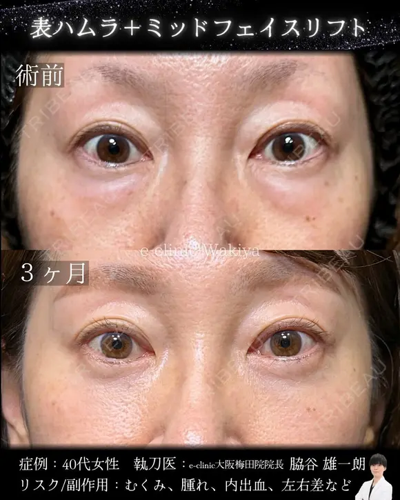 表ハムラ・ミッドフェイスリフト before画像 メイン用