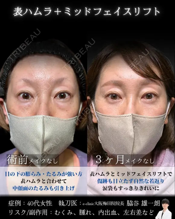 表ハムラ・ミッドフェイスリフト 90日後 メイン用