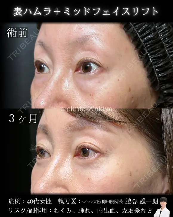 表ハムラ・ミッドフェイスリフト 90日後 メイン用