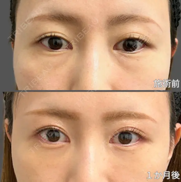 くまとり施術 30日後 メイン用