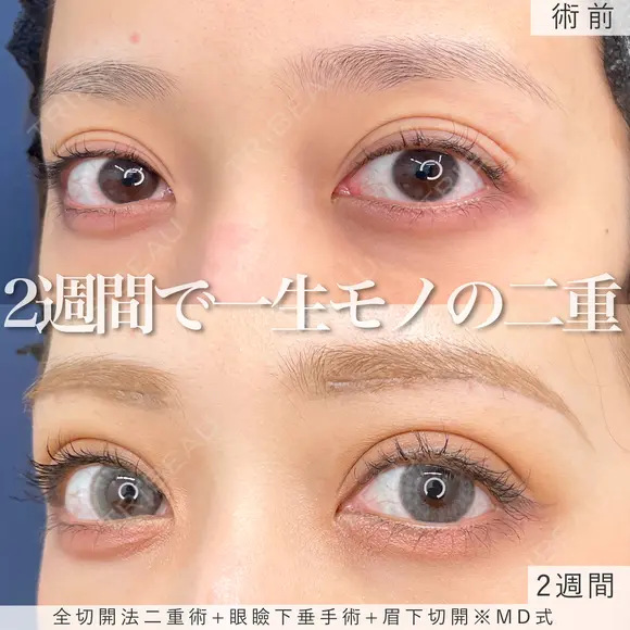 MD式全切開法二重術+MD式眼瞼下垂手術+MD式眉下切開 after画像 メイン用