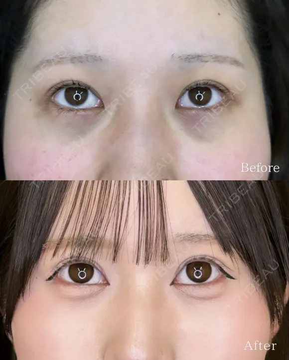 目の下のくまとり before画像 メイン用