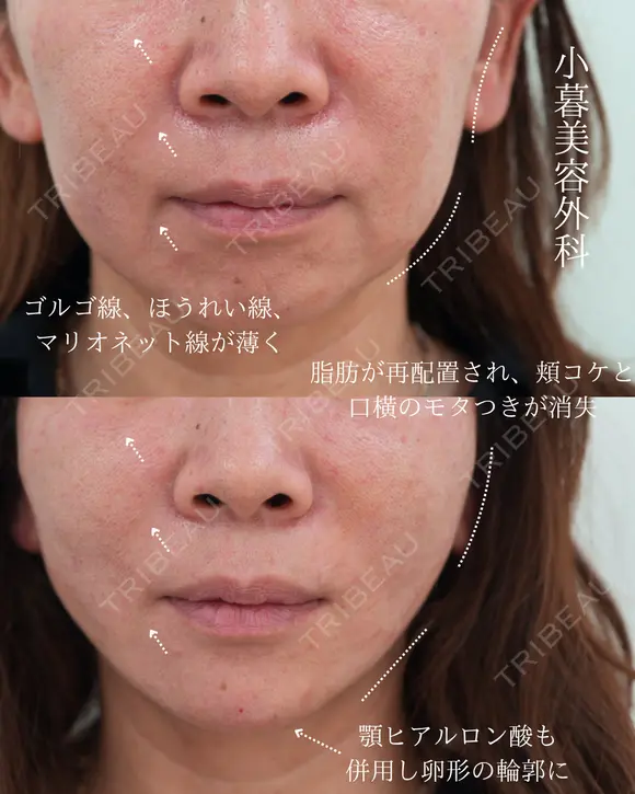 PCL糸リフト、顎ヒアルロン酸 before画像 メイン用