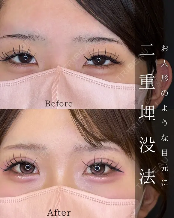 二重埋没 after画像 メイン用