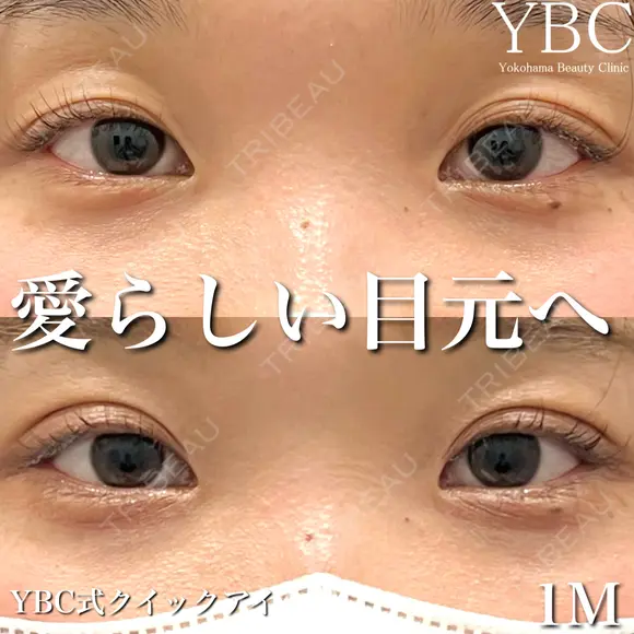 【🍦YBC式クイックアイ🍦】 before画像 メイン用