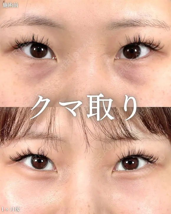山本のクマ取り after画像 メイン用