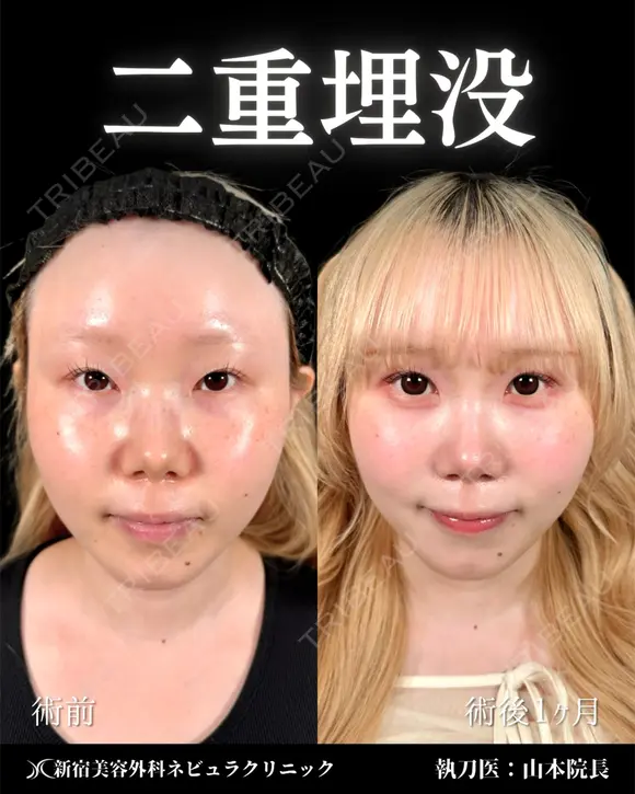 山本による🎀垢抜け二重🎀 after画像 メイン用