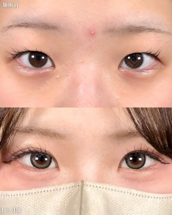 山本による🎀垢抜け二重🎀 before画像 メイン用