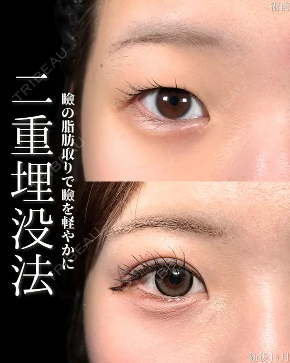 山本による🎀垢抜け二重🎀 after画像 メイン用