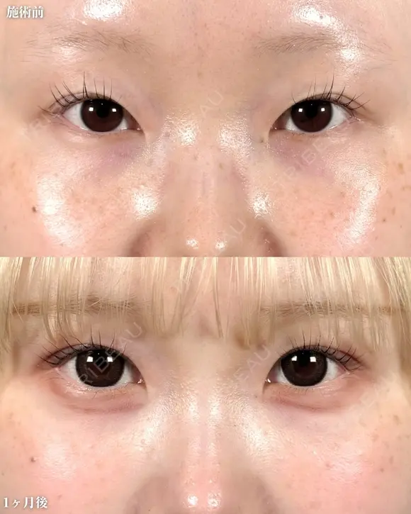 山本による🎀垢抜け二重🎀 before画像 メイン用