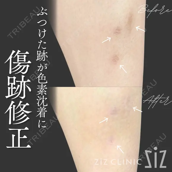 【傷跡修正】ぶつけた跡が色素沈着に after画像 メイン用