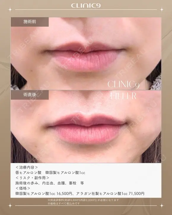 唇ヒアルロン酸　韓国製ヒアルロン酸1cc before画像 メイン用