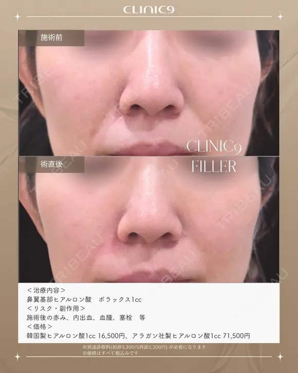鼻翼基部ヒアルロン酸　ボラックス1cc after画像 メイン用