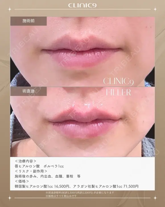 唇ヒアルロン酸 ボルベラ1cc after画像 メイン用