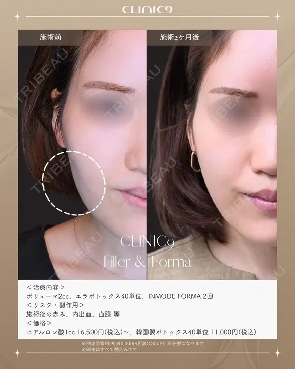 ヒアルロン酸×ボトックス×INMODE FORMA before画像 メイン用