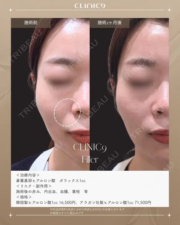 鼻翼基部ヒアルロン酸 ボラックス1cc before画像 メイン用