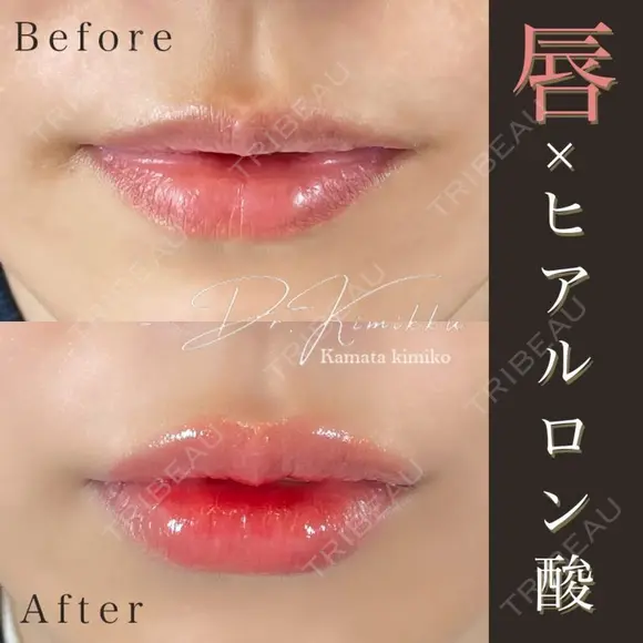 唇のヒアルロン酸注射 after画像 メイン用