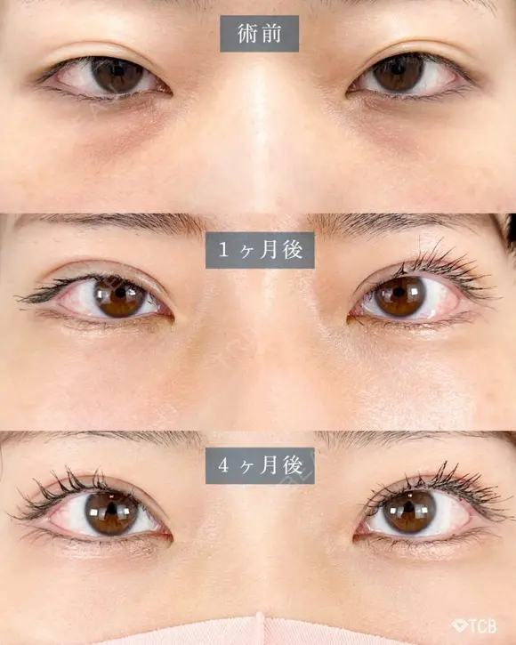 二重切開法（全切開・部分切開） before画像 メイン用