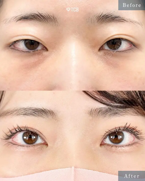 二重切開法（全切開・部分切開） after画像 メイン用
