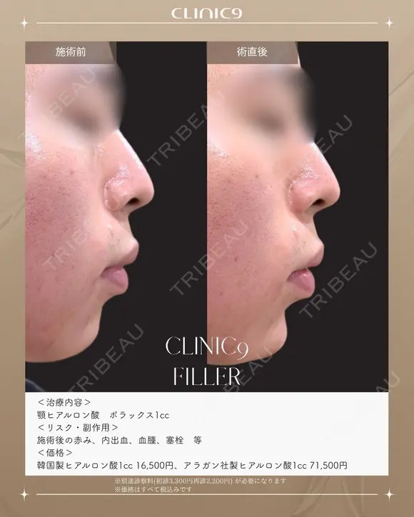 顎ヒアルロン酸 ボラックス1cc before画像 メイン用