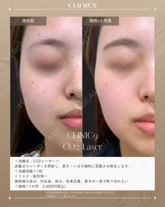 CO2レーザー　ホクロ・イボ除去 before画像 メイン用