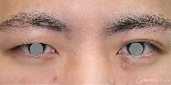 【20代男性・左右差を整える】二重埋没法（マイクロメソッド+α）（1ヶ月後） before画像 メイン用
