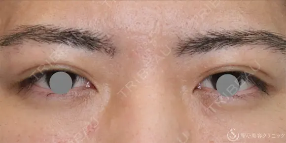【20代男性・左右差を整える】二重埋没法（マイクロメソッド+α）（1ヶ月後） 30日後 メイン用