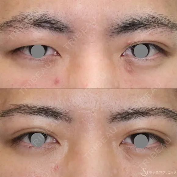 【20代男性・左右差を整える】二重埋没法（マイクロメソッド+α）（1ヶ月後） 30日後 メイン用