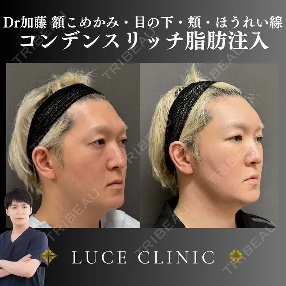 コンデンスリッチ脂肪注入 before画像 メイン用