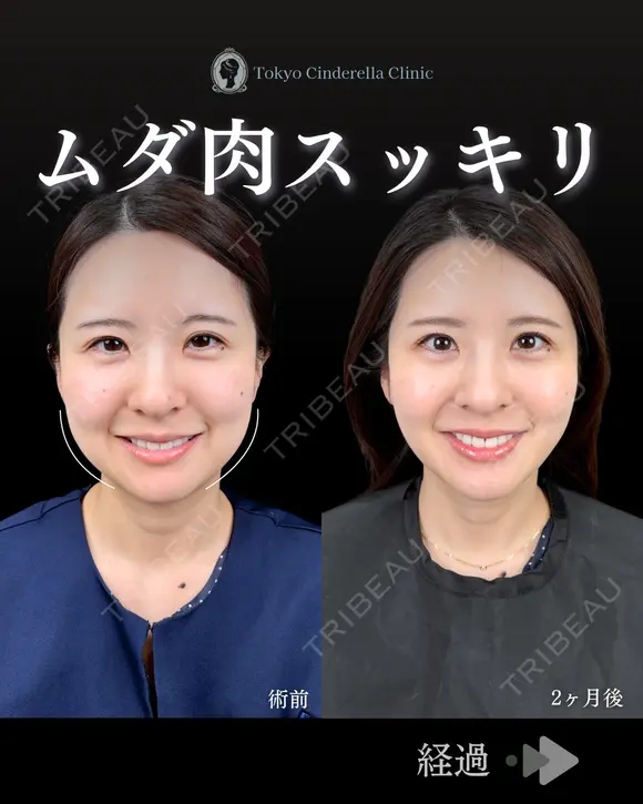 小顔脂肪吸引（頬・あご下）/クイックリフト8本 30日後 メイン用