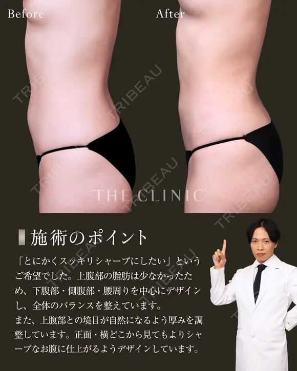 ポッコリお腹にバイバイ！吸引で叶えるヘルシー美腹筋✨｜お腹の360°脂肪吸引 after画像 メイン用