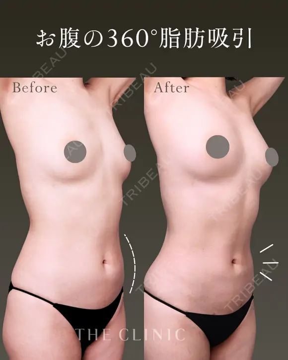 ポッコリお腹にバイバイ！吸引で叶えるヘルシー美腹筋✨｜お腹の360°脂肪吸引 before画像 メイン用