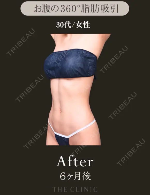 綺麗なアブクラックスラインを脂肪吸引で✨｜お腹の360°脂肪吸引 after画像 メイン用